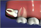 Wisdom Teeth Horizontal Impaction