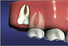 Wisdom Teeth Vertical Impaction